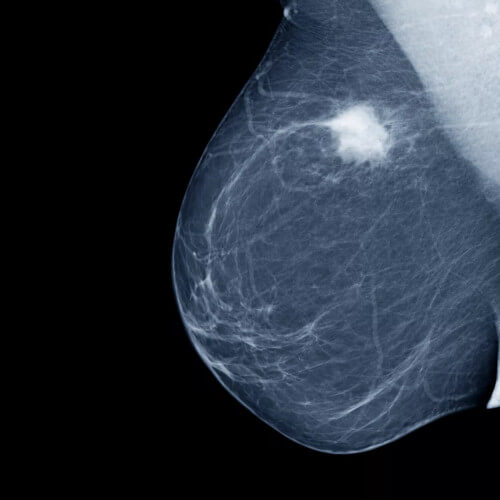 Image Mammographie image