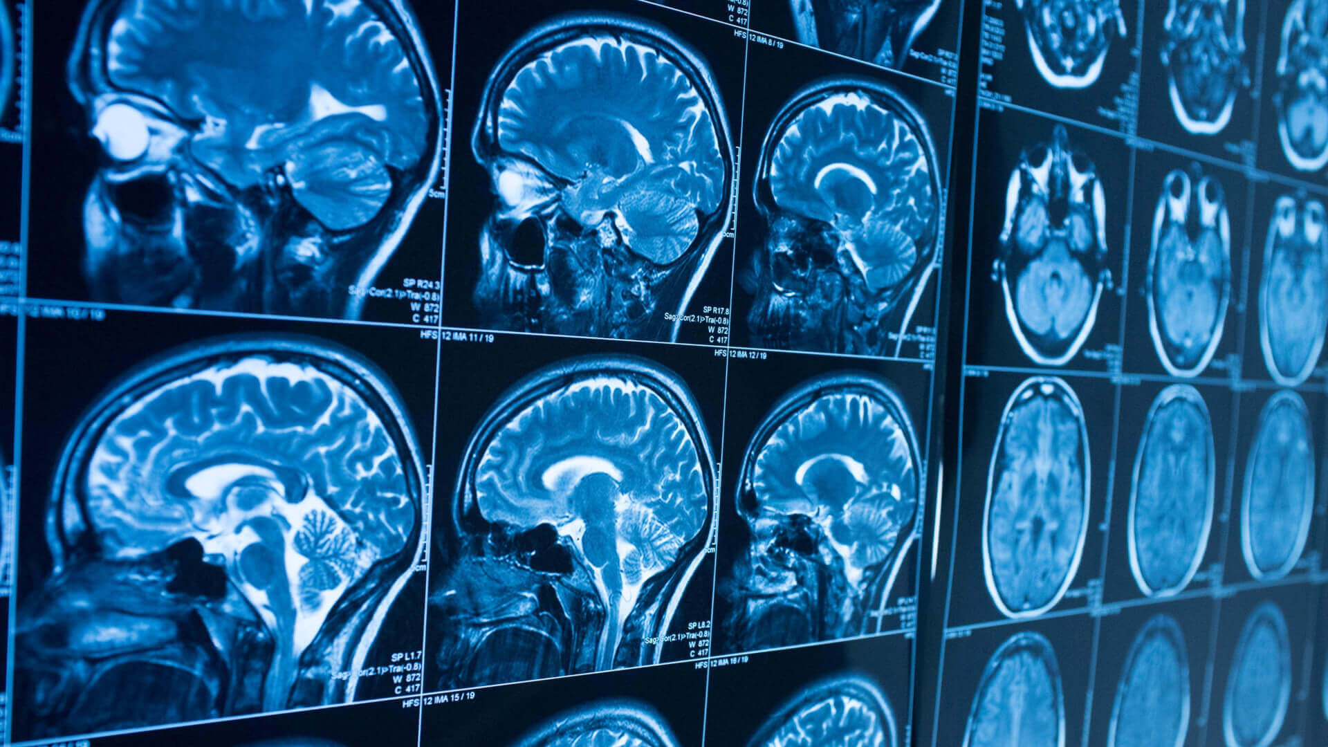Image de scintigraphie du cerveau